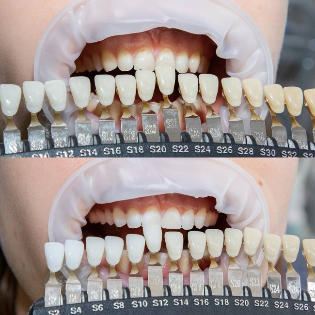 система офисного отбеливания зубов